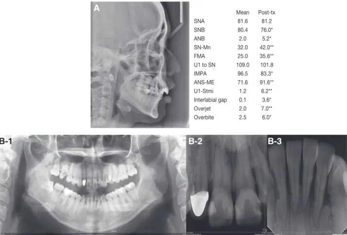 Fig. 2. (A) Pretreatment lateral cephalometric radiograph and analysis. Deep overbite and large overjet were observed
