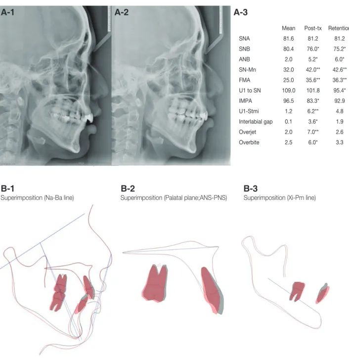 Fig. 5. Pretreatment, posttreatment lateral cephalometric radiographs (A) and superimposition analysis (B)