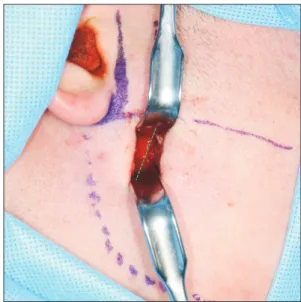 Fig. 1. A. Landmark line for the skin incision. A line was drawn, 2 cm long, at 1 cm anterior to and parallel to the placement of a conven- conven-tional preauricular incision