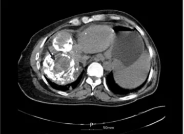 Fig. 5. Abdominal dynamic computed tomography scan. Several  hepatocellular carcinoma masses in the liver (arrows).