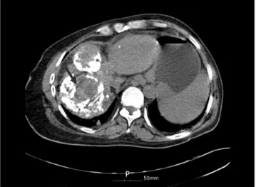 Fig. 5. Abdominal dynamic computed tomography scan. Several  hepatocellular carcinoma masses in the liver (arrows).