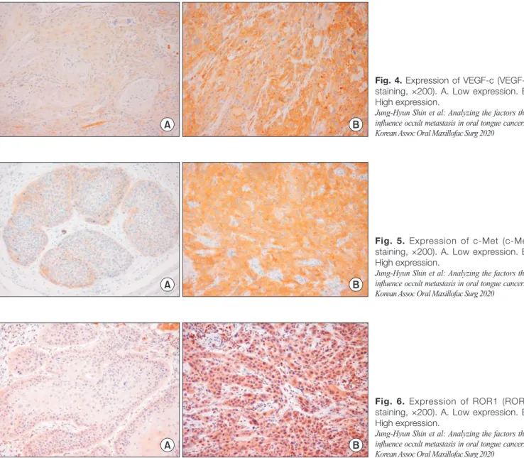 Fig. 4. Expression of VEGF-c (VEGF-c  staining, ×200). A. Low expression. B. 