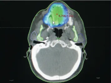 Fig. 1. Radiation dosage distribution map of the osteoradionecro- osteoradionecro-sis area.