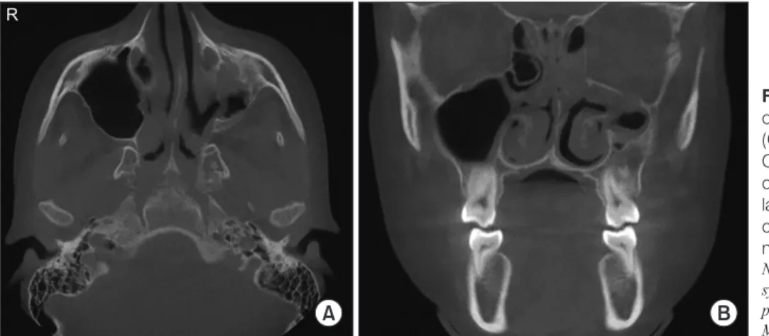 Fig. 4. Axial (A) and coronal (B) slices  of cone-beam computed tomography  (CBCT). Axial and coronal slices of  CBCT from December 2015 confirm  ostiomeatal obstruction of the left  maxil-lary sinus in an asymptomatic  12-year-old female patient, leading 