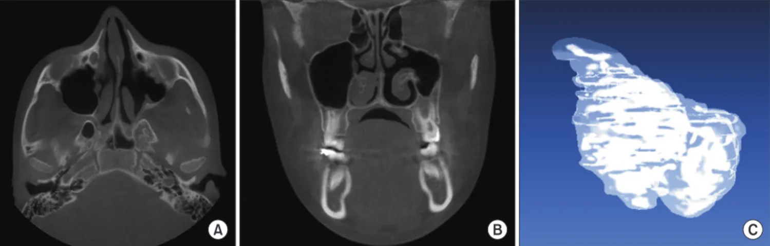 Fig. 5. Axial (A) and coronal (B) slices of cone-beam computed tomography (CBCT) and an approximation of the segmented left maxil- maxil-lary sinus (C)