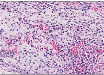 Fig. 2. Histologic feature. Langerhans cells and eosinophils are  densely infiltrated