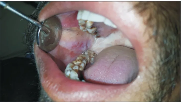 Fig. 5. Three years postoperative result, extra oral scar was ac- ac-ceptable to the patient.