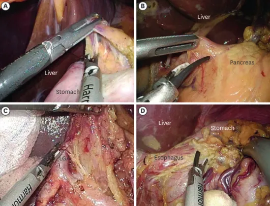 Fig. 2.  Laparoscopic view of the prebent (Olympus Medical Systems Corp.) forceps in performing lymphadenectomy  during single-port laparoscopic distal gastrectomy