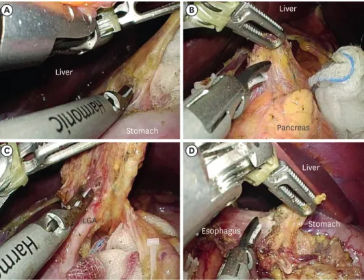 Fig. 3.  Laparoscopic view of the multi-DOF articulating device in lymphadenectomy during single-port laparoscopic  distal gastrectomy