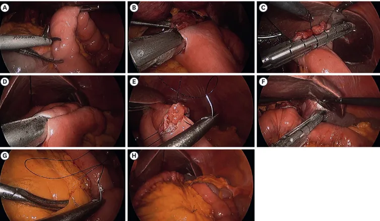 Fig. 1.  Operative procedures of total laparoscopic total gastrectomy without mesentery division