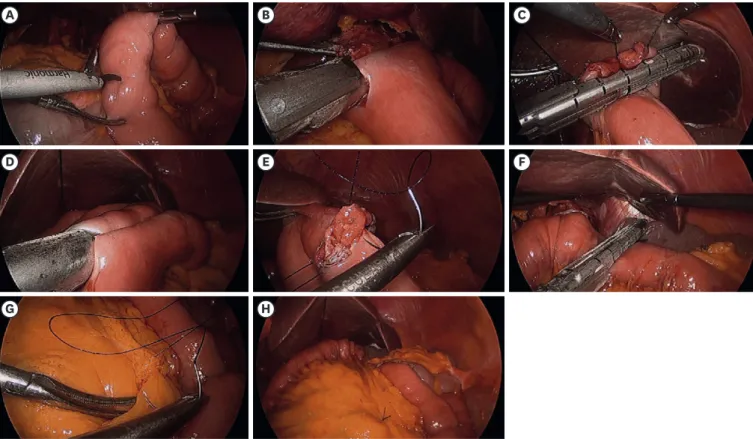 Fig. 1.  Operative procedures of total laparoscopic total gastrectomy without mesentery division