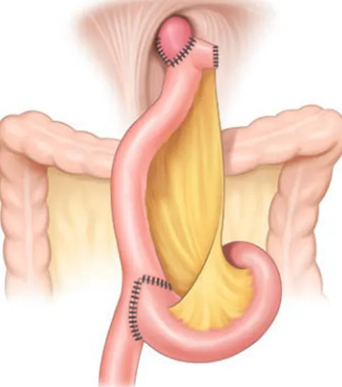 Fig. 2.  Anastomosis after total laparoscopic total gastrectomy without mesentery division.