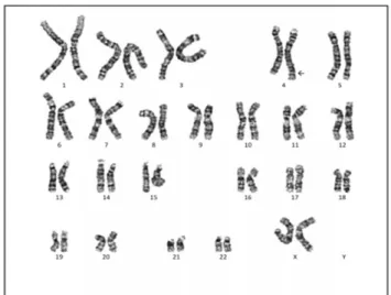Fig. 2.  Chromosome study; 46, XX, der(4)t(4;10)(q35;p12.2)pat. The 4q35.1 deletion with 10 duplication was found in the chromosomal  study.
