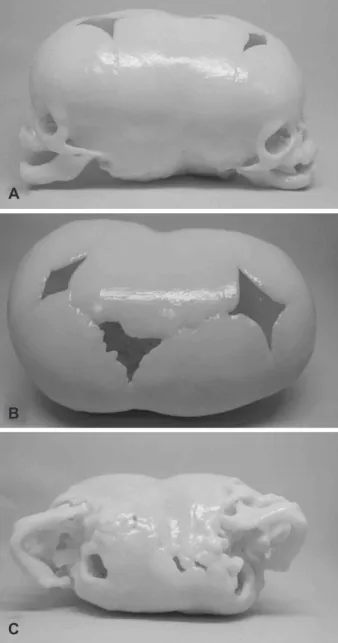 Fig. 1. A-D: 3D printed model of a craniopagus patient. The print- print-ed model can provide rich information compare to the traditional  medical data visualization system.