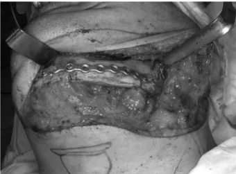 Fig. 1. Marking of the surgical resection margin in the 3D RP mod- mod-el and fabrication of surgical stent for fibular reconstruction