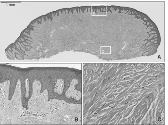 Fig. 2.  Histopathology under  hematoxyline­eosin staining  of case 1. (A) A nodular mass  consisting of stratified squa­ mous epithelium and dense  fibrous connective tissue (×40)