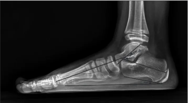 Figure 1. Radiographic parameters are shown on weight-bearing lateral ra- ra-diograph