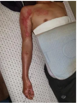 Fig. 1. Multiple acupuncture treatment on burn area(2020/10/20). 