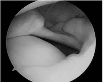 Fig. 3. A root tear of the medial meniscus. Fig. 4. Debridement of tear site using an arthroscopic shaver.