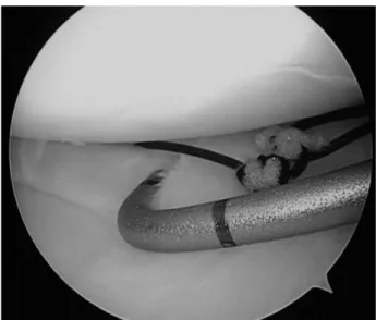 Fig. 12. Two all-inside sutures are tied securely for the radial