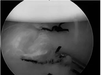 Fig. 17. A suture anchor is inserted into the insertion area of