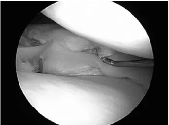 Fig. 19. A posterior horn tear of the lateral meniscus is repaired