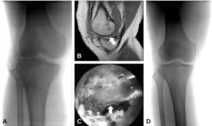 Fig. 4. Arthroscopic reduction of irreducible knee dislocation. (A) Knee subluxation on X-ray before arthroscopic reduction, (B) Interposition of Vastus medialis (arrow) in notch and medial compartment on MRI, (C) Interposition of Vastus medialis (arrow) i