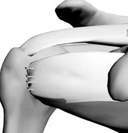 Fig. 3. Illustration showing well repaired subscapularis at bursal side.