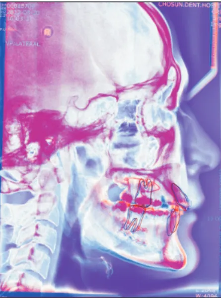 Table 1. Horizontal and vertical positions of B point and pogonion (Pog) at the pre-surgery (T0), immediately after surgery (T1), and long- long-term post-surgery (T2) stages