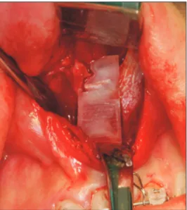 Fig. 2. Photograph of the placement of the surgical guide for  dento-osseous segmental osteotomy of the left anterior maxillary  region.