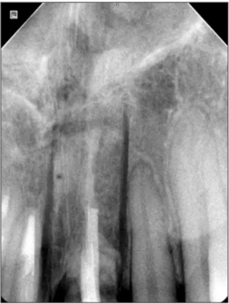 Fig. 3. Postoperative apical radiograph of the left maxillary central  incisor region.