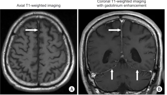 Figure 2.  Magnetic resonance imaging  of a patient with diffuse hypertrophic  pachymeningeal tuberculosis (after  treatment)