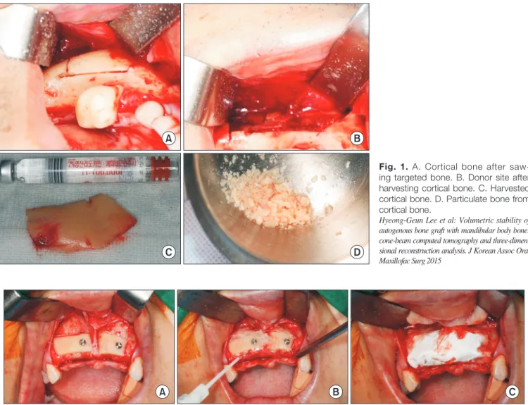 Fig. 1. A. Cortical bone after saw- saw-ing targeted bone. B. Donor site after  harvesting cortical bone