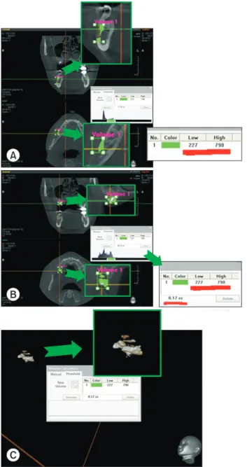 Fig. 3. A. Evaluating adjacent cortical bone not harvested with the  grayscale range. B