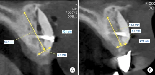 Fig. 4. A. Cross-section of grafted  bone 1 day after grafting surgery. B. 
