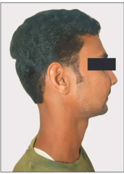 Fig. 1. Preoperative swelling on the right midface region. 