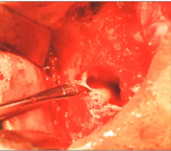 Fig. 6. Antral pack and closure. 