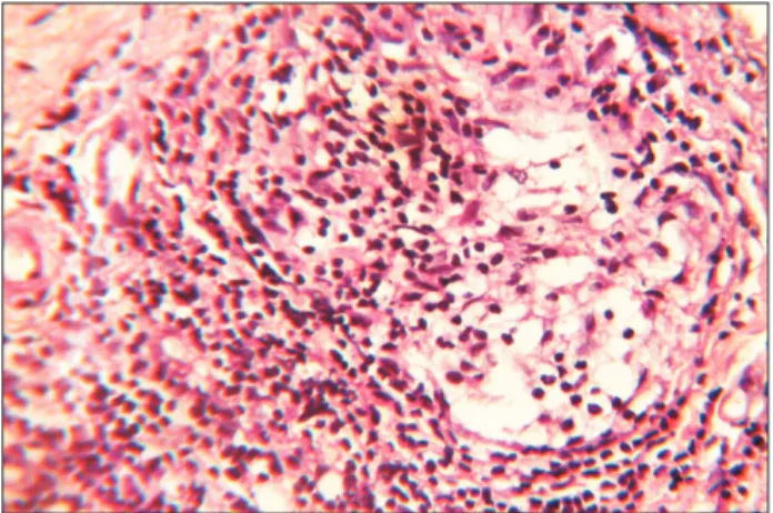 Fig. 10. H&amp;E stained low power (×10) section shows chronic in- in-fl ammatory cells, multinucleated giant cells and connective tissue.