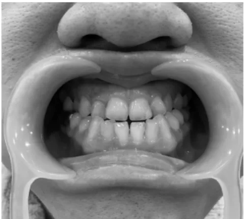 Fig. 1. Patient’s posture before (A) andFig.  2.  Class  III  malocclusion.