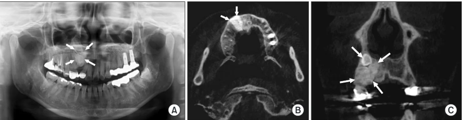 Fig. 1. Preoperative panoramic radiopraph (A) and computed tomography (CT) scans (B, C) show compound odontoma associated with  failure of permanent canine eruption
