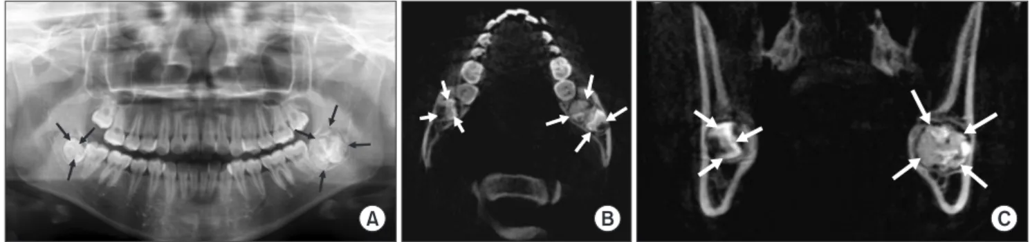 Fig. 6. Preoperative panoramic radiopgraph (A) and computed tomography scans (B, C) show a compound odontoma with impacted 3rd  molar, contacting above the bony canal of inferior alveolar nerve (left, 4 arrows)