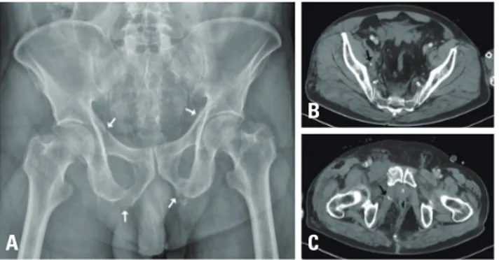 Fig. 3.  (A) Femur anteroposterior radiographs present intact femur  bone. An enhanced computed tomography scan demonstrates active  extravasation of the muscular branch of the right deep femoral artery  (black arrow) in the (B) axial view and (C) coronal 