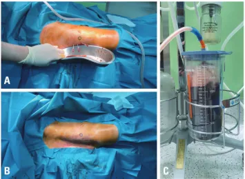 Fig. 8.  (A) Percutaneous needle drainage at the middle of the lesion,  where fluid has accumulated
