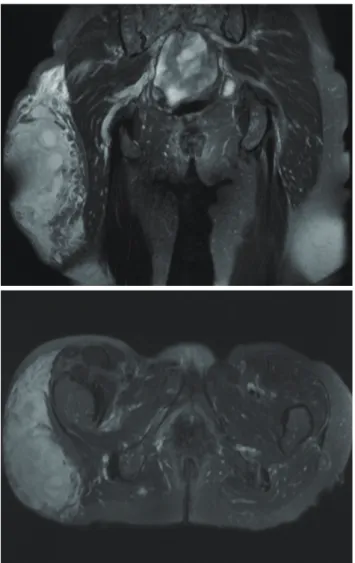 Fig. 3.  After incision and drainage, negative-pressure wound therapy  was applied to the incision area.