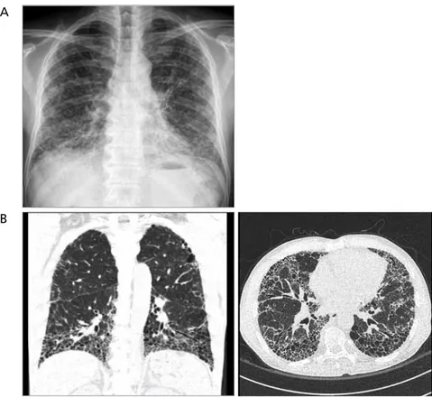 Figure 3.  Typical usual interstitial pneumonia pattern of chest X-ray and high-resolution computed  tomography of patient with idiopathic pulmonary fibrosis