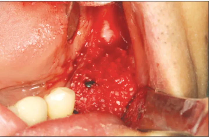 Fig. 3. Implants  were  placed  and  dehiscence  defects  were covered autogenous tooth bone graft material.