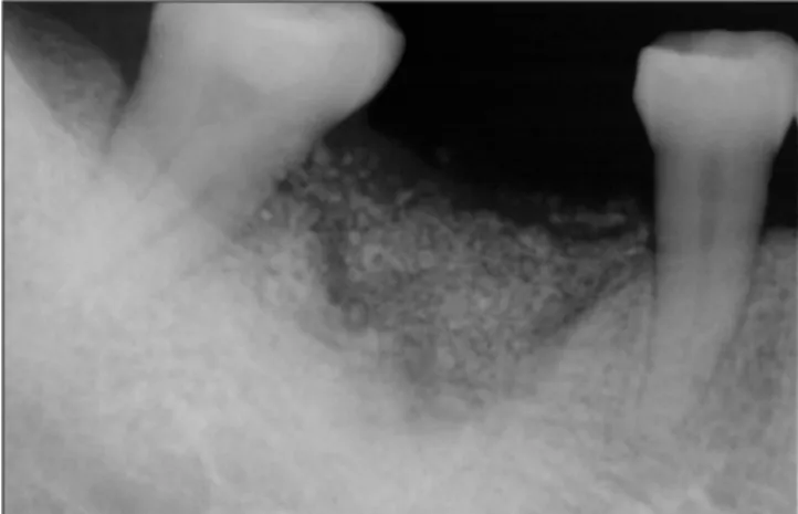 Fig. 8. Guided  bony  regeneration  (GBR)  was  performed  at right  1st  molar  area  of  49-year  old  female  patient.