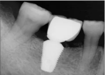 Fig. 14. Periapical radiography of 50-year old male patient 2 months after extraction of mandibular left 1st molar.