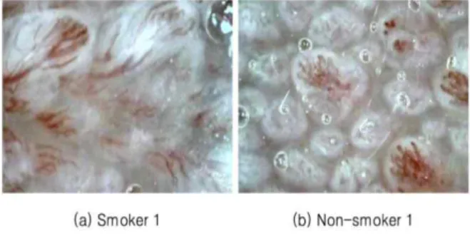 Figure 8. Results of tangue buds between smokers and non-smokers. 