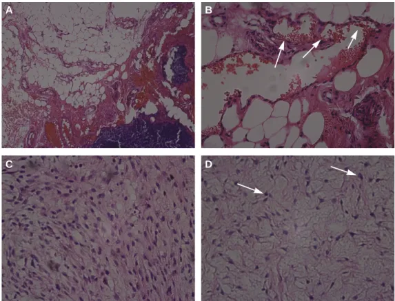 Fig. 4. A. The tumor is composed of spindle or stellate cells lying in an abundant amorphous myxoid stroma that also con- con-tains isolate coarse and fine collagen fiber bundles.(H&amp;E staining, original magnification ×10) B